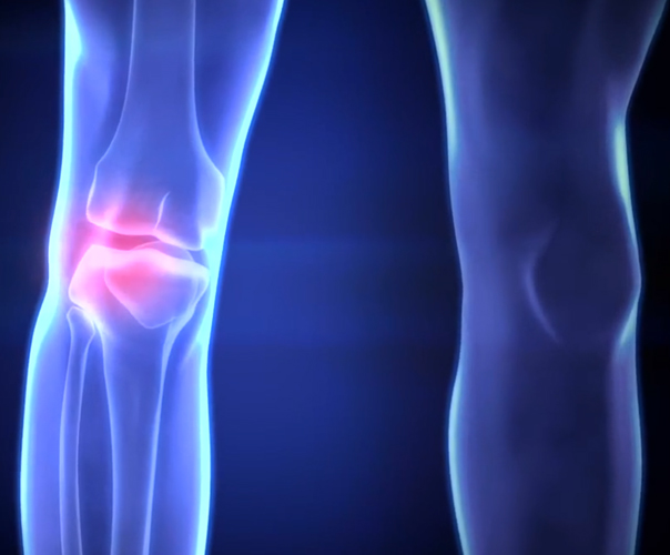 Attelle de Genou - Reaction - Bleue 